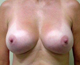 Breast Lift and Augmentation after 1341189