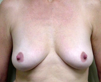 Breast Lift and Augmentation before 1341189