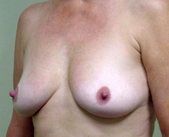 Breast Lift and Augmentation 1341189