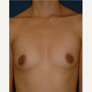 18-24 year old woman treated with Breast Augmentation before 3577103