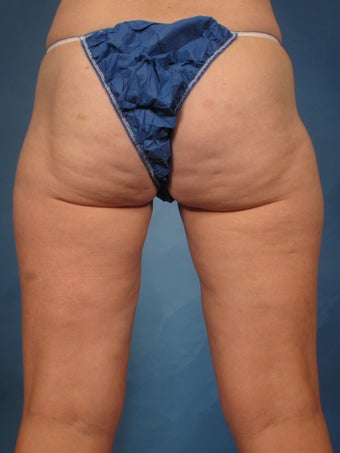 45 year old treated with CoolSculpting of the inner thighs 1192722