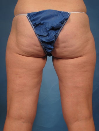45 year old treated with CoolSculpting of the inner thighs 1192722