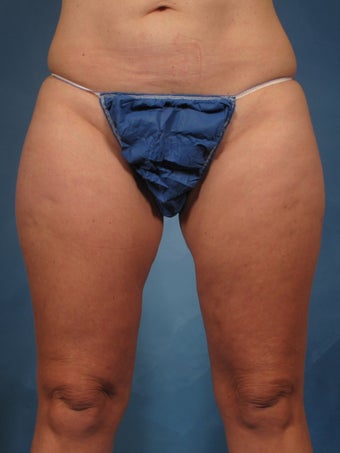 45 year old treated with CoolSculpting of the inner thighs before 1192722