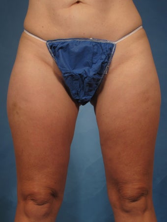 45 year old treated with CoolSculpting of the inner thighs after 1192722