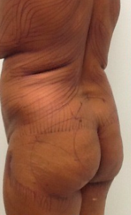 45-54 year old woman treated with Brazilian Butt Lift before 2477796