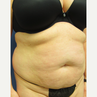 35-44 year old woman treated with Tummy Tuck & Limited Liposuction before 3082696