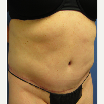 35-44 year old woman treated with Tummy Tuck & Limited Liposuction after 3082696