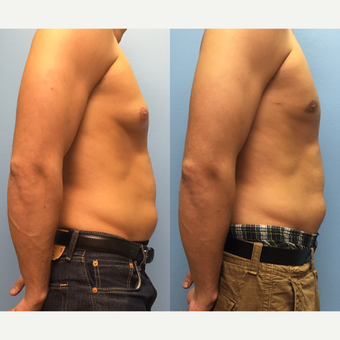 29 year old man treated with Male Breast Reduction before 3174592