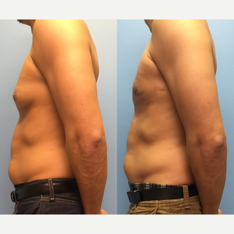 29 year old man treated with Male Breast Reduction after 3174592