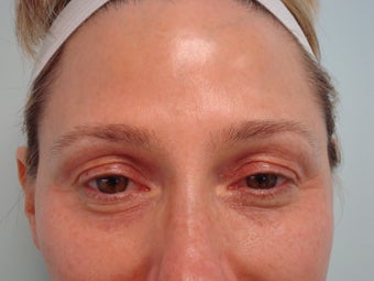 Under Eye filler treatment before 583358