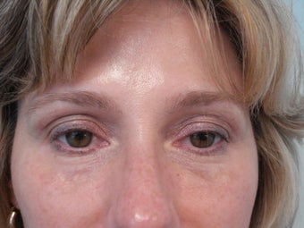 Under Eye filler treatment after 583358