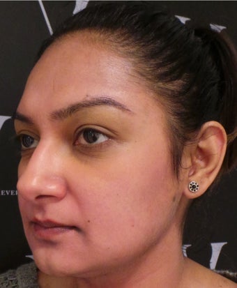 Hyperpigmenation treatment after 3127359