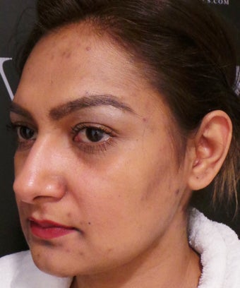 Hyperpigmenation treatment before 3127359
