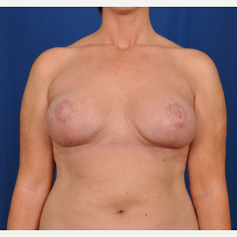 25-34 year old woman treated with Breast Reduction after 3240012