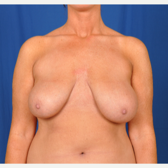 25-34 year old woman treated with Breast Reduction before 3240012