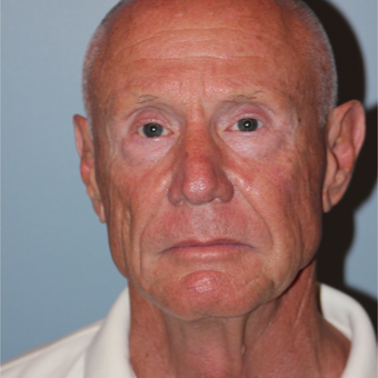 67 year old man treated with MACS Facelift before 3465109