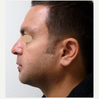 35-44 year old man treated with Rhinoplasty after 3660171