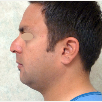 35-44 year old man treated with Rhinoplasty before 3660171