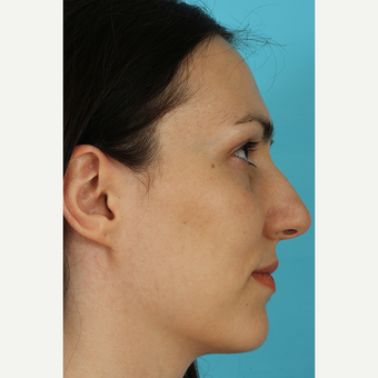 25-34 year old woman treated with Rhinoplasty before 3690803