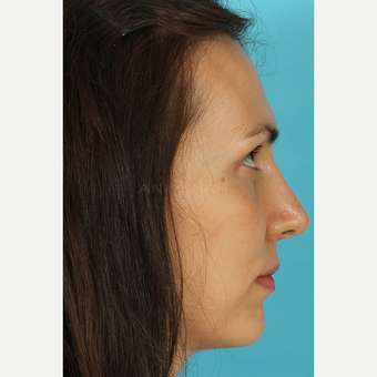 25-34 year old woman treated with Rhinoplasty after 3690803