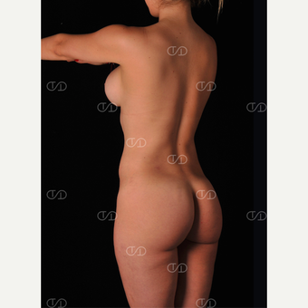 25-34 year old woman treated with Brazilian Butt Lift after 2849886