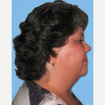 Neck Lift before 3824770