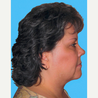 Neck Lift after 3824770