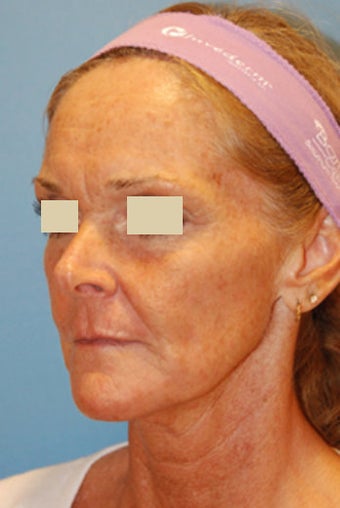 The YoungVitalizer: The Incision Less Face Lift before 166186