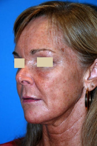 The YoungVitalizer: The Incision Less Face Lift after 166186