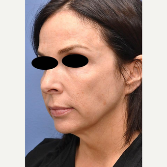 45-54 year old woman treated with Profound RF before 3689799