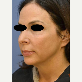 45-54 year old woman treated with Profound RF after 3689799