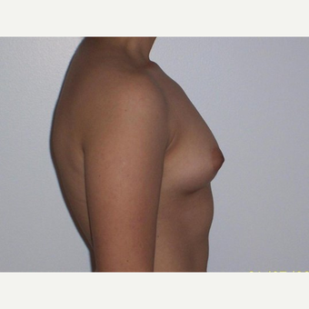 Breast Augmentation before 3560799
