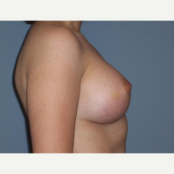 Breast Augmentation after 3560799