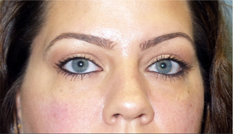 Cannula eye lift with Restylane for under-eye bags (tear trough) after 3291838