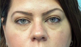 Cannula eye lift with Restylane for under-eye bags (tear trough) before 3291838