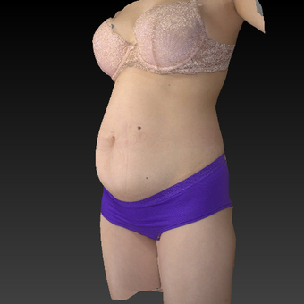 35-44 year old woman treated mini tummy tuck before 3783781