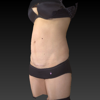 35-44 year old woman treated mini tummy tuck after 3783781