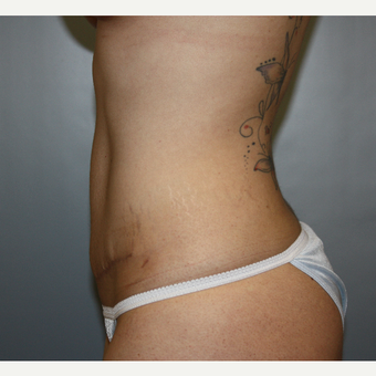 25-34 year old woman treated with Tummy Tuck after 3808915
