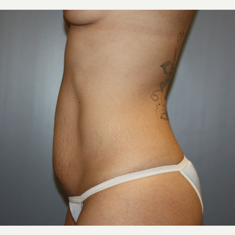 25-34 year old woman treated with Tummy Tuck before 3808915