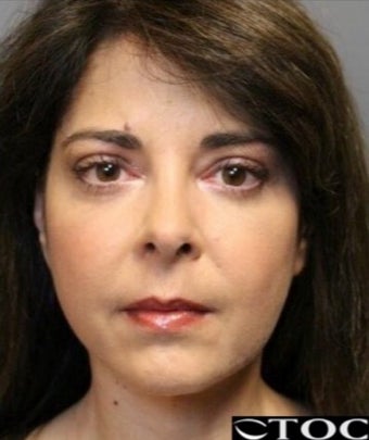 45-54 year old woman treated with Laser Resurfacing after 3046845