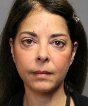 45-54 year old woman treated with Laser Resurfacing before 3046845