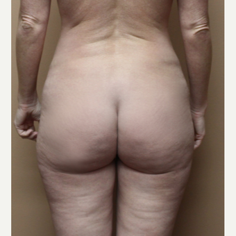 25-34 year old woman treated with Brazilian Butt Lift before 3213694