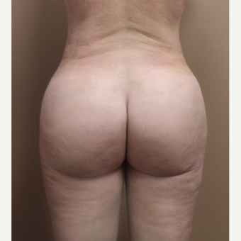 25-34 year old woman treated with Brazilian Butt Lift after 3213694