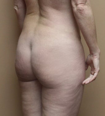 25-34 year old woman treated with Brazilian Butt Lift 3213694