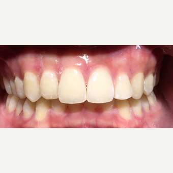 Metal Braces can do alot in nine months after 3135247