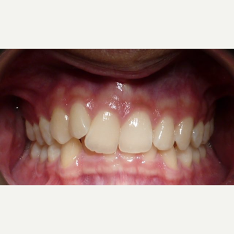Metal Braces can do alot in nine months before 3135247