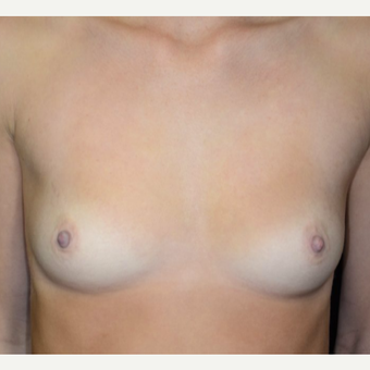 18-24 year old woman treated with Breast Augmentation before 3099323