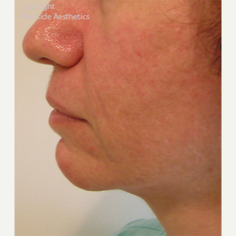 Radiesse Chin Enhancement after 2972565