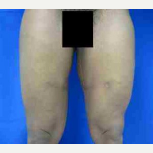 Thigh Lift after 3094386