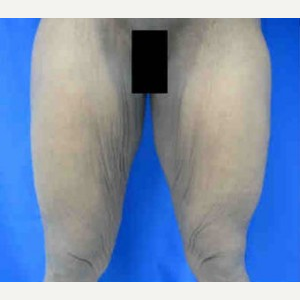 Thigh Lift before 3094386